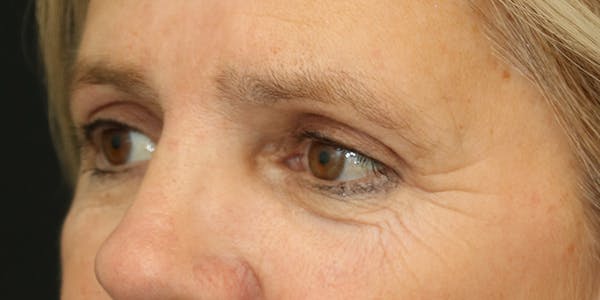 Eyelid Surgery Gallery - Patient 60806650 - Image 4
