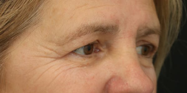 Eyelid Surgery Before & After Gallery - Patient 60806650 - Image 5