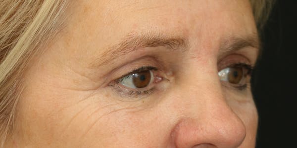 Eyelid Surgery Before & After Gallery - Patient 60806650 - Image 6