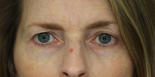 before and after brow lift