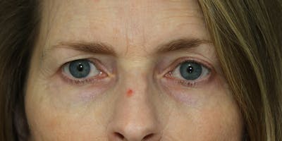 Brow Lift Before & After Gallery - Patient 60806833 - Image 1