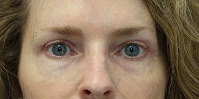 Brow Lift Before & After Gallery - Patient 60806833 - Image 2