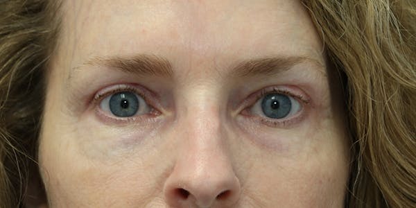 before and after brow lift