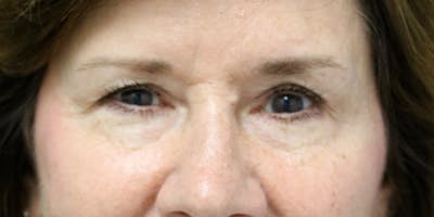 Brow Lift Before & After Gallery - Patient 60806834 - Image 1