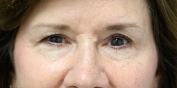 Brow Lift Before & After Gallery - Patient 60806834 - Image 1