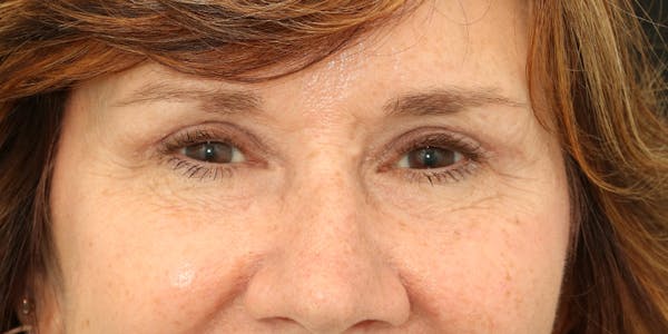 Brow Lift Before & After Gallery - Patient 60806834 - Image 2