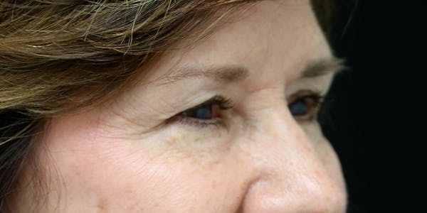 before and after brow lift photos