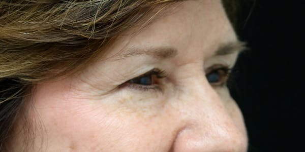 Brow Lift Before & After Gallery - Patient 60806834 - Image 3