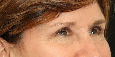 Brow Lift Before & After Gallery - Patient 60806834 - Image 4
