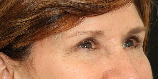 Brow Lift Before & After Gallery - Patient 60806834 - Image 4