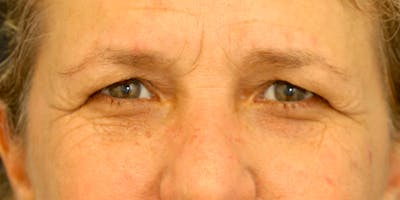 Brow Lift Before & After Gallery - Patient 60806835 - Image 1