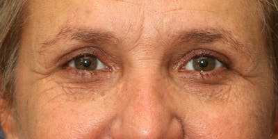 Brow Lift Before & After Gallery - Patient 60806835 - Image 2