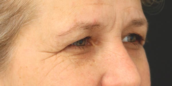 Brow Lift Before & After Gallery - Patient 60806835 - Image 3