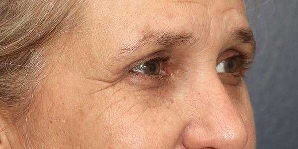 Brow Lift Before & After Gallery - Patient 60806835 - Image 4