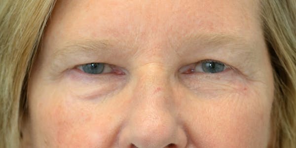 Brow Lift Before & After Gallery - Patient 60806836 - Image 1
