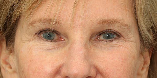 Brow Lift Before & After Gallery - Patient 60806836 - Image 2