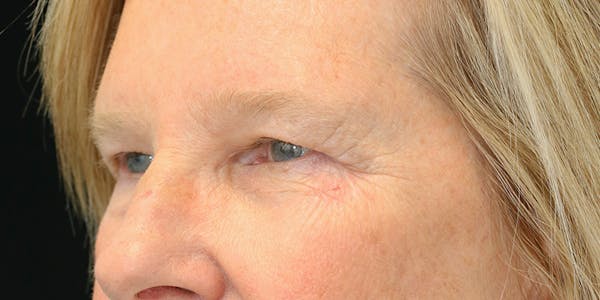 Brow Lift Before & After Gallery - Patient 60806836 - Image 3