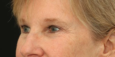 Brow Lift Before & After Gallery - Patient 60806836 - Image 4