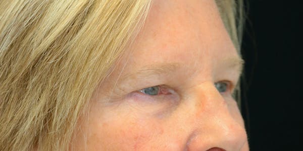 Brow Lift Before & After Gallery - Patient 60806836 - Image 5
