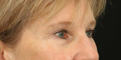 Brow Lift Before & After Gallery - Patient 60806836 - Image 6
