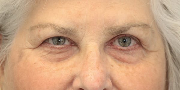 Brow Lift Before & After Gallery - Patient 60806837 - Image 1
