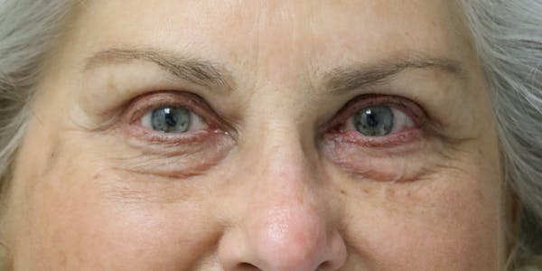 Brow Lift Before & After Gallery - Patient 60806837 - Image 2