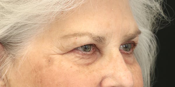 Brow Lift Before & After Gallery - Patient 60806837 - Image 3