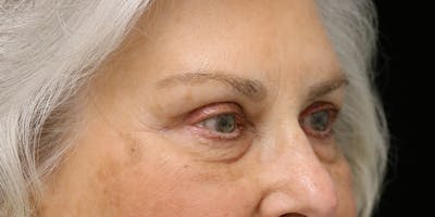 Brow Lift Before & After Gallery - Patient 60806837 - Image 4