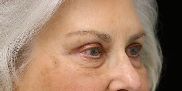 Brow Lift Before & After Gallery - Patient 60806837 - Image 4
