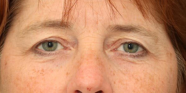 Brow Lift Before & After Gallery - Patient 60806838 - Image 1