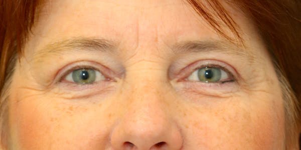 Brow Lift Before & After Gallery - Patient 60806838 - Image 2