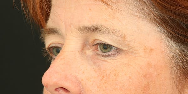 Brow Lift Before & After Gallery - Patient 60806838 - Image 3