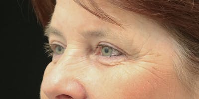 Brow Lift Before & After Gallery - Patient 60806838 - Image 4