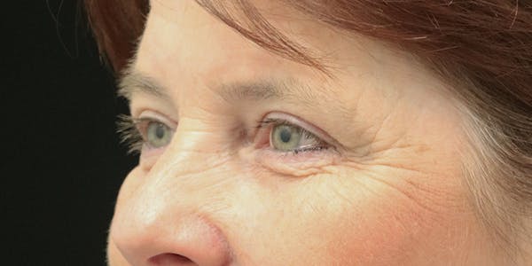 Brow Lift Before & After Gallery - Patient 60806838 - Image 4