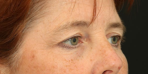 Brow Lift Before & After Gallery - Patient 60806838 - Image 5