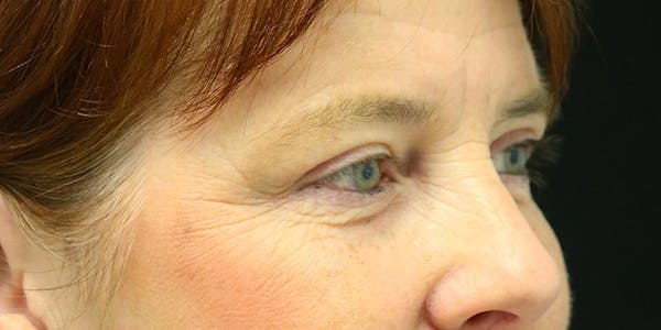 Brow Lift Before & After Gallery - Patient 60806838 - Image 6
