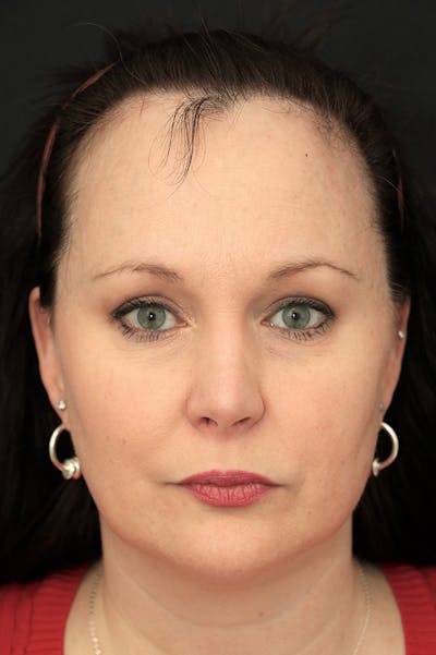 Hairline Advancement Before & After Gallery - Patient 60806870 - Image 1