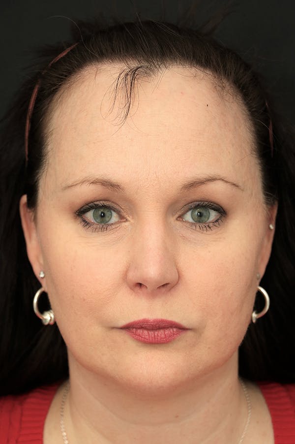 Hairline Advancement Before & After Gallery - Patient 60806870 - Image 1