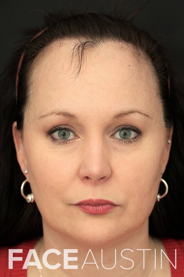 Hairline Advancement Before & After Gallery - Patient 60806870 - Image 1