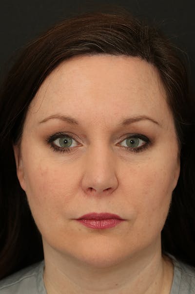 Hairline Advancement Before & After Gallery - Patient 60806870 - Image 2