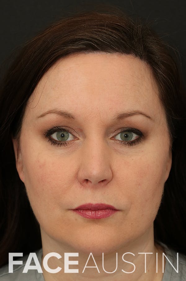 Hairline Advancement Before & After Gallery - Patient 60806870 - Image 2