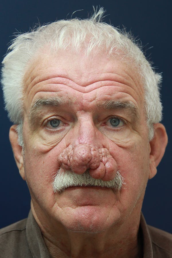 Rhinophyma Surgery Gallery - Patient 60806981 - Image 1