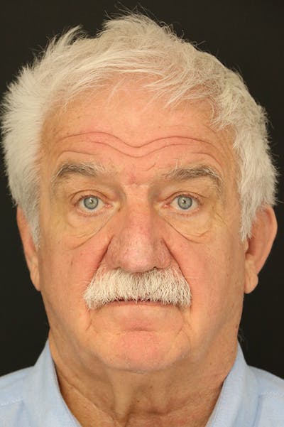 Rhinophyma Surgery Before & After Gallery - Patient 60806981 - Image 2
