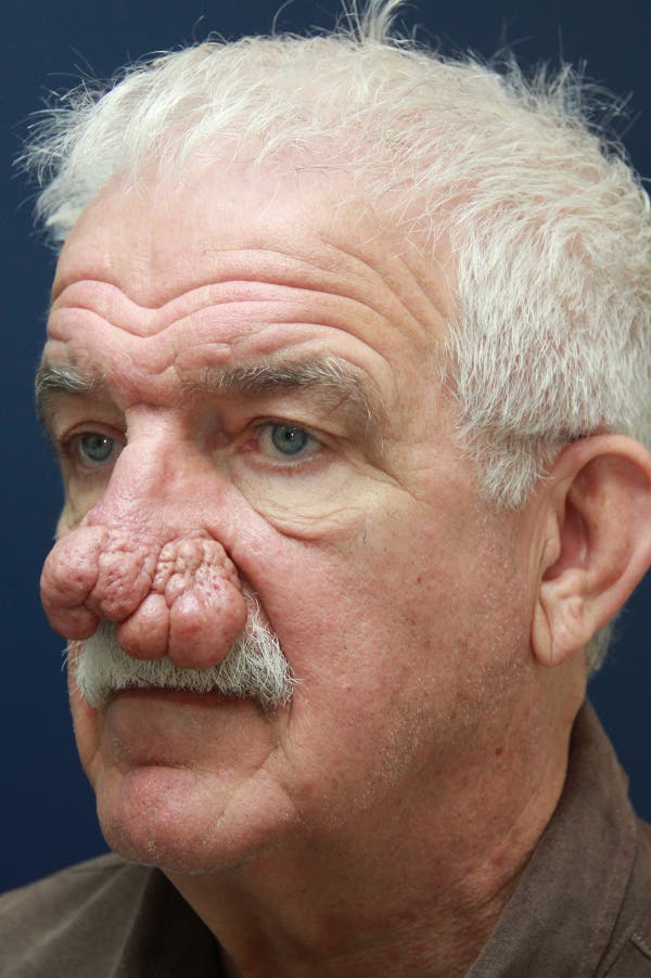 Rhinophyma Surgery Before & After Gallery - Patient 60806981 - Image 3