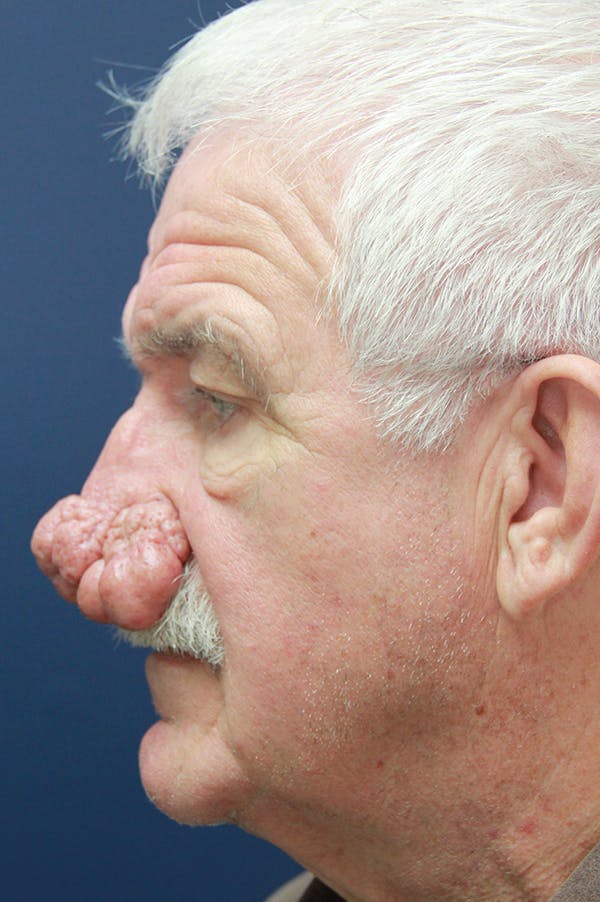Rhinophyma Surgery Before & After Gallery - Patient 60806981 - Image 5