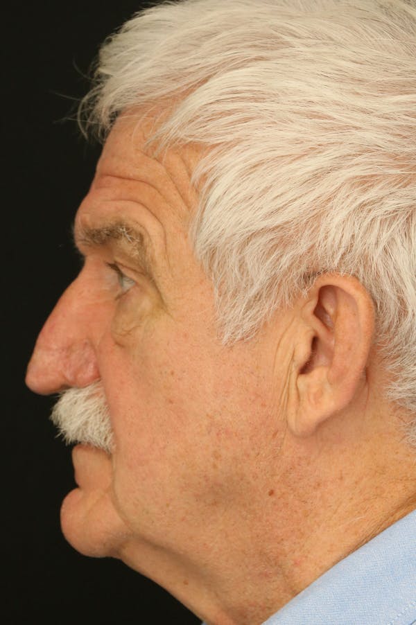 Rhinophyma Surgery Before & After Gallery - Patient 60806981 - Image 6