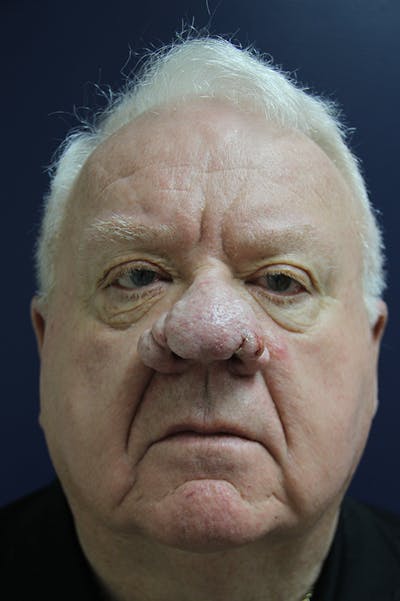 Rhinophyma Surgery Before & After Gallery - Patient 60806982 - Image 1