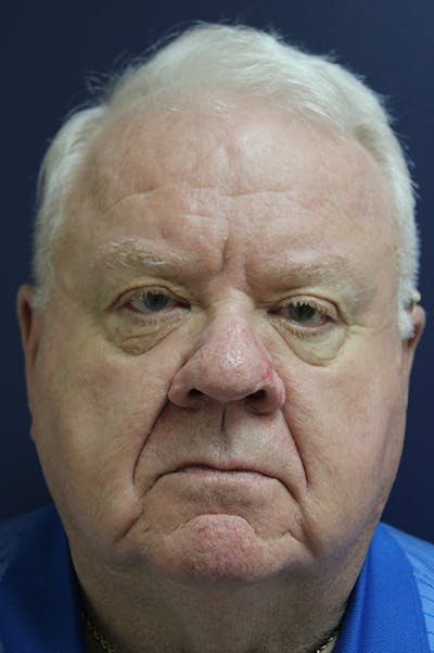 Rhinophyma Surgery Before & After Gallery - Patient 60806982 - Image 2