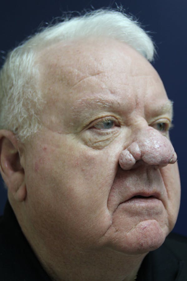 Rhinophyma Surgery Before & After Gallery - Patient 60806982 - Image 3