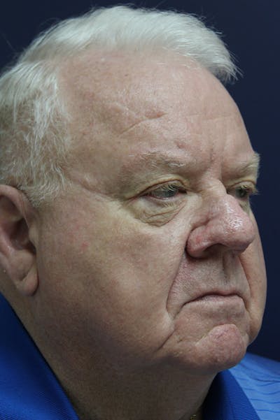 Rhinophyma Surgery Before & After Gallery - Patient 60806982 - Image 4